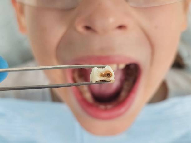 Best Emergency Dentist for Knocked-Out Tooth in Dilley, TX